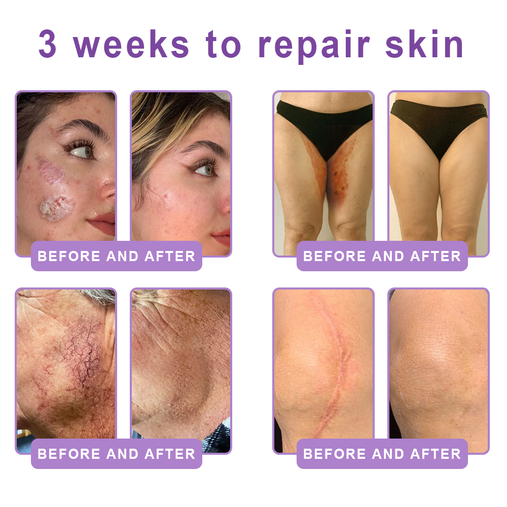 Hudros® PDRN Multi-Peptide Massaging Body Roller Cream- Anti-aging, Hydrating, Skin Firming & Lifting, Skin Repair, Even Tone, Acne and Dark Spot Treatment, Wart and Mole Removal, and Psoriasis Relief.