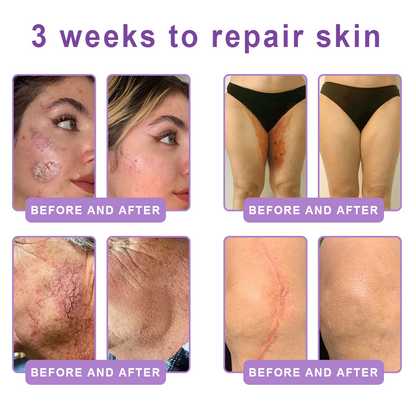 Hudros® PDRN Multi-Peptide Massaging Body Roller Cream- Anti-aging, Hydrating, Skin Firming & Lifting, Skin Repair, Even Tone, Acne and Dark Spot Treatment, Wart and Mole Removal, and Psoriasis Relief.