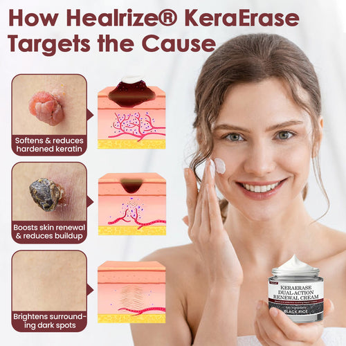 🇦🇺👨‍⚕️Australian Dermatology Recommendations:: Healrize® KeraErase Dual-Action Renewal Cream