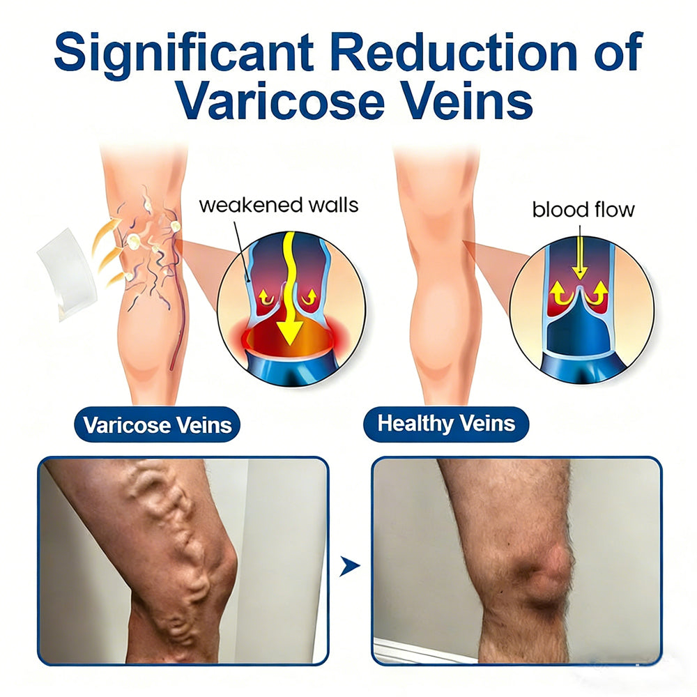 𝐏𝐮𝐫𝐞𝐥𝐨𝐫𝐚® 𝐃𝐢𝐨𝐬𝐦𝐢𝐧 & 𝐀𝐞𝐬𝐜𝐢𝐧 𝐕𝐞𝐢𝐧 𝐂𝐨𝐧𝐭𝐨𝐮𝐫 𝐌𝐢𝐜𝐫𝐨𝐧𝐞𝐞𝐝𝐥𝐞 𝐏𝐚𝐭𝐜𝐡 🌿𝟕-𝐃𝐚𝐲 𝐕𝐢𝐬𝐢𝐛𝐥𝐞 𝐑𝐞𝐬𝐮𝐥𝐭𝐬 𝐟𝐨𝐫 𝐕𝐚𝐫𝐢𝐜𝐨𝐬𝐞 𝐕𝐞𝐢𝐧𝐬 - 𝐀𝐝𝐯𝐚𝐧𝐜𝐞𝐝 𝐇𝐞𝐫𝐛𝐚𝐥 𝐁𝐥𝐞𝐧𝐝 𝐓𝐚𝐫𝐠𝐞𝐭𝐬 𝐒𝐩𝐢𝐝𝐞𝐫 𝐕𝐞𝐢𝐧𝐬 & 𝐑𝐞𝐥𝐢𝐞𝐯𝐞𝐬 𝐇𝐞𝐚𝐯𝐲, 𝐓𝐢𝐫𝐞𝐝 𝐋𝐞𝐠𝐬🦵