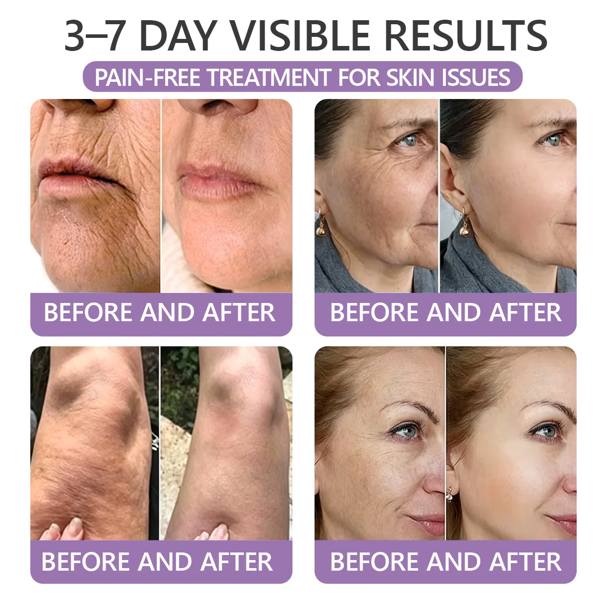 Hudros® PDRN Multi-Peptide Massaging Body Roller Cream- Anti-aging, Hydrating, Skin Firming & Lifting, Skin Repair, Even Tone, Acne and Dark Spot Treatment, Wart and Mole Removal, and Psoriasis Relief.